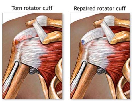 Shoulder Surgery Singapore Renowned Surgeonrepair Tear