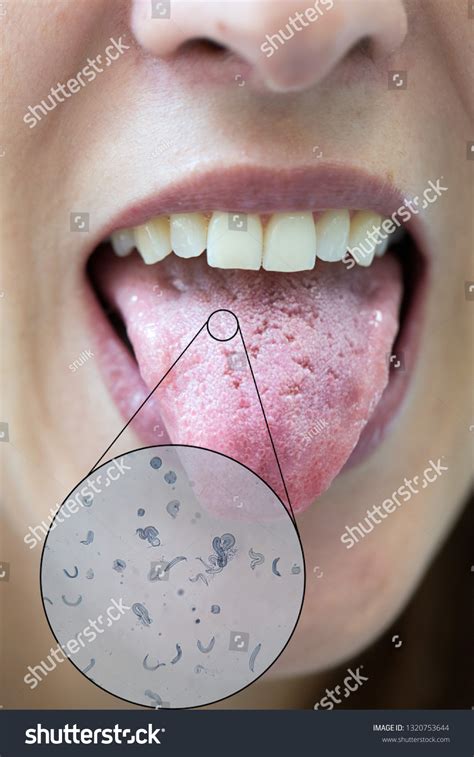 Bacterial Infection On Tongue