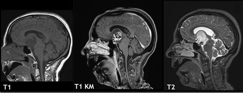 Craniopharyngioma On A Mri R Radiology