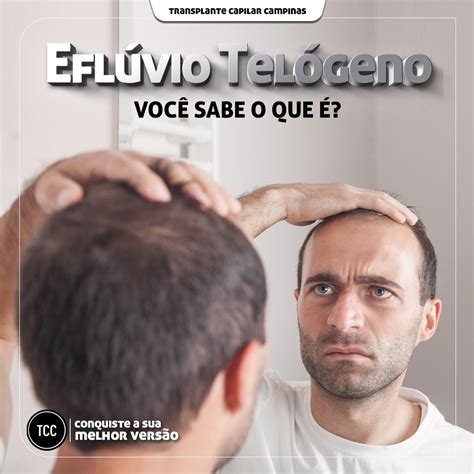 Transplante Capilar Em Campinas - Transplante Capilar | Campinas SP