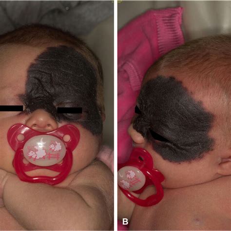 A Frontal And B Side View Of Medium Sized Congenital Melanocytic