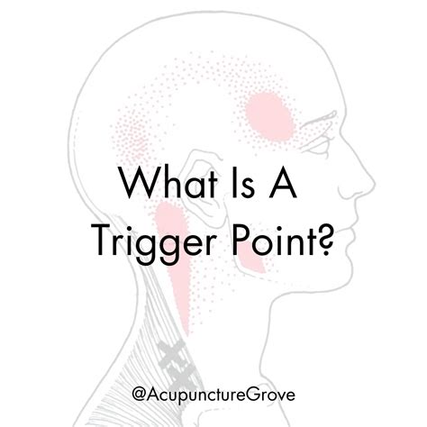 What Is A Trigger Point?