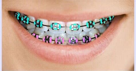 Braces Color Combos — Good Day Orthodontics Santa Maria Ca