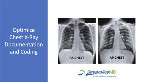 Optimize Chest X Ray Documentation And Coding Streamlinemd