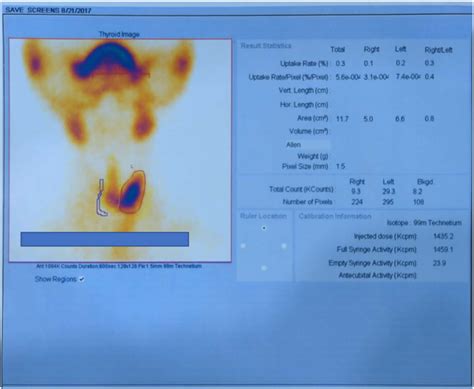 Radionuclide Thyroid Uptake Scan Post Operative Revealing Residual