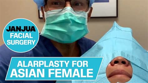 Alarplasty For Asian Female From Connecticut Dr Tanveer Janjua New