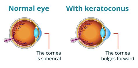 About Keratoconus The Eye Practice