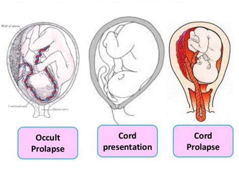 Umbilical Cord Accidents | Best Hospital in Trivandrum for High Risk Pregnancy Care