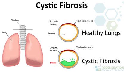 Stem Cell Therapy for Cystic Fibrosis & CFTR Mediators