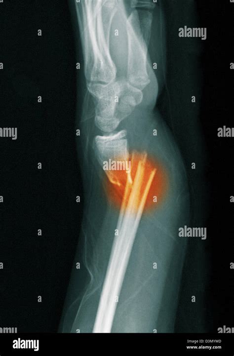 X Ray Montrant Une Fracture De La Partie Distale Du Radius Et Cubitus