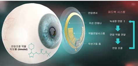 안압 진단하고 치료할 수 있는 스마트 콘택트렌즈 개발 전자신문