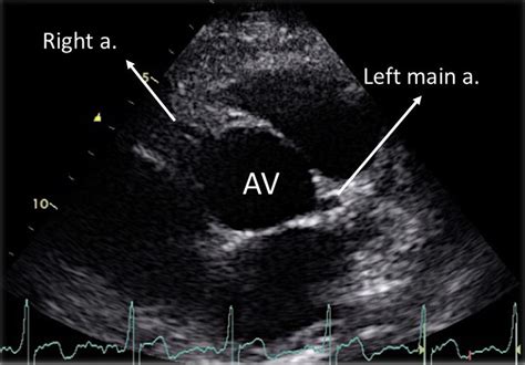 Parasternal Transthoracic Short Axis View Showing The Aortic Valve With