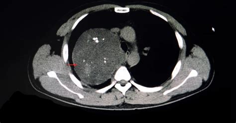 Mediastinal Tumor treatment in Gurgaon & Delhi | Dr. Parveen Yadav