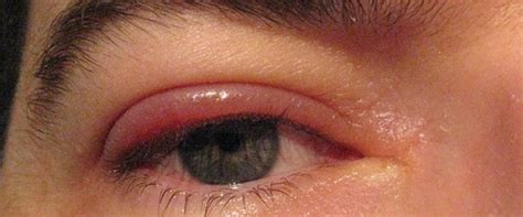 What Causes Swollen Eyelids? | Eye Disorders and Diseases medical answers | Body & Health ...