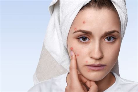 4 Perbedaan Rosacea Dan Jerawat Yang Perlu Diketahui