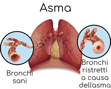 Asma Bronchiale Sintomi Allergia Terapia