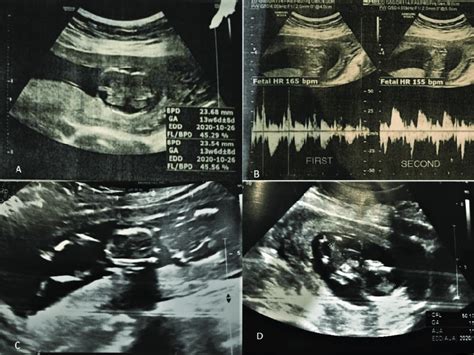 A Longitudinal Section Of Twins Mimicking Singleton Pregnancy At Download Scientific Diagram