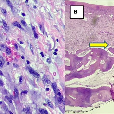 Histological findings of malignant fibrous histiocytoma (cont'd) All ...