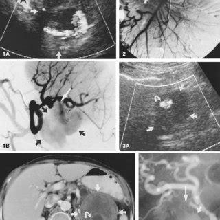 Case Superior Mesenteric Angiogram Demonstrating Extravasation Of