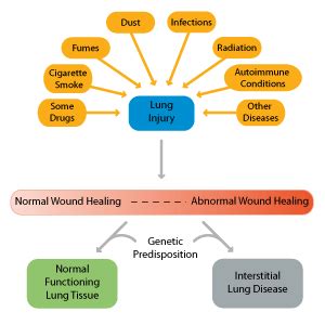 Pulmonary Fibrosis Causes Types Symptoms Diagnosis Stages Treatment Images