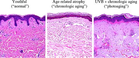 The Translational Basis Of Human Cutaneous Photoaging The American