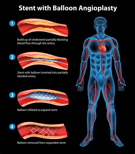 Save Your Heart With Angioplasty And Stents