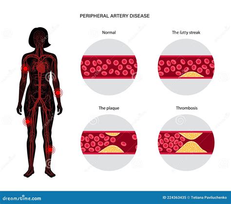 Doença Arterial Periférica Ilustração Do Vetor Ilustração De Anatomia