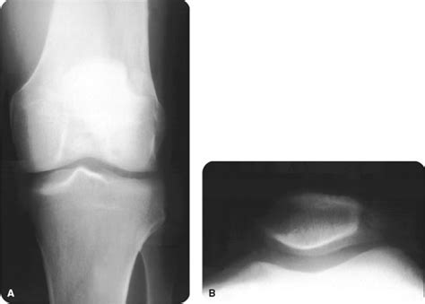 Bipartite Patella | Radiology Key