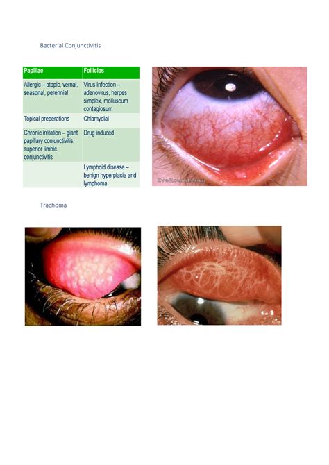 Bacterial Conjunctivitis - Bacterial Conjunctivitis Trachoma Viral ...