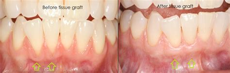 Gingival Graft Before And After