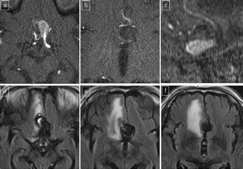 Figure 1 From Anterior Communicating Artery Aneurysm With A Peculiar Angiographic Appearance A