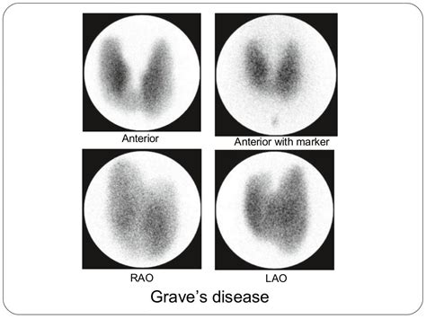 Radionuclide Imaging Thyroid And Parathyroid