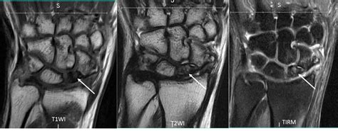 Avascular Necrosis Of Scaphoid Bone Radiology Cases