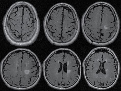 Charcot Marie Tooth Disease Type 1a And Inflammatory Demyelinating Lesions In The Central