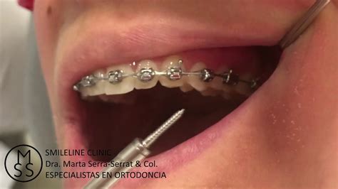 Colocacion De Minitornillos Maximo Anclaje Smileline Clinic Barcelona