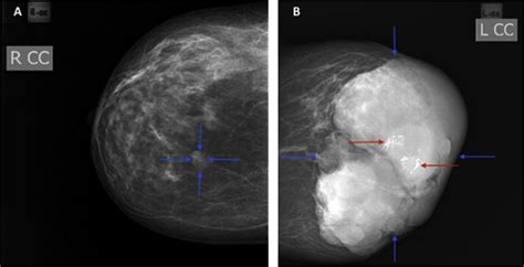 Mammogram Imaging Of The Left Breast A The Right Craniocaudal View