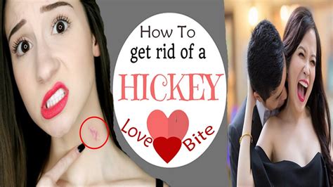 How To Get Rid Of A Hickey Home Remedies For Kiss Marks Remove