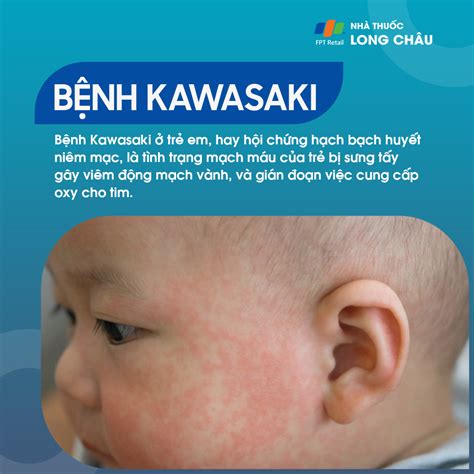 benh kawasaki  tre em trieu chung nguyen nhan va cach dieu tri