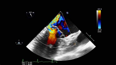 Color Doppler Test In Thane Jinkushal Cardiac Care Superspeciality