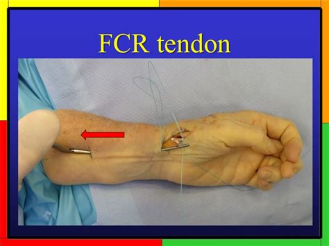 Fcr Interposition