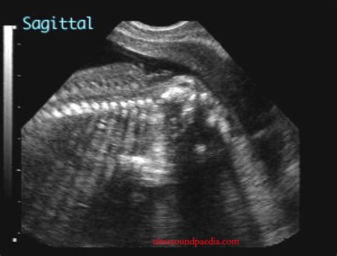 Anencephaly – ULTRASOUNDPAEDIA