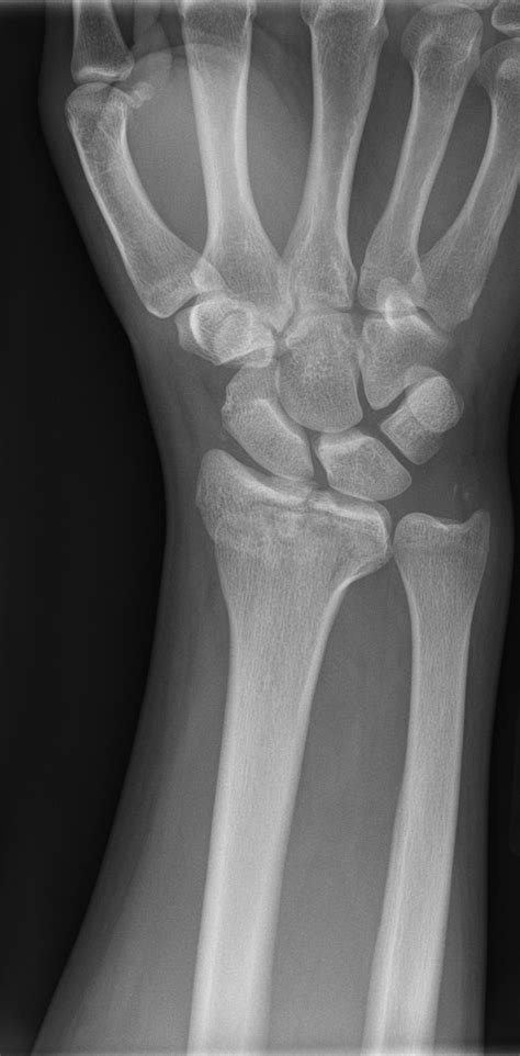 Barton Fracture Radiology Case Radshare Net