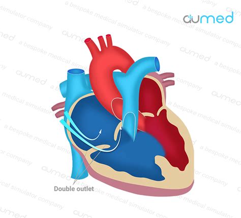 Double Outlet Right Ventricle (DORV) – AuMed