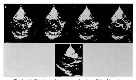 Figure 3 From Chaotic Echo Motion In The Left Ventricular Cavity