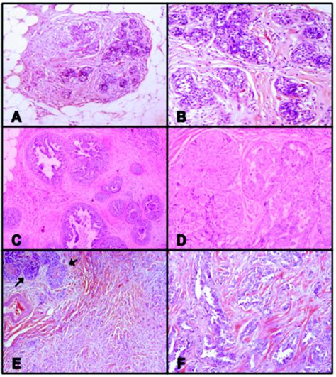 Representative Photomicrographs Case 95 Lobular Carcinoma In