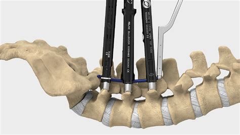 XLIF 20 Years Of XLIF NuVasive Minimally Invasive Surgery