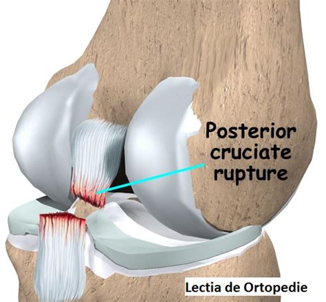 Ruptura Ligamentului Incrucisat Posterior