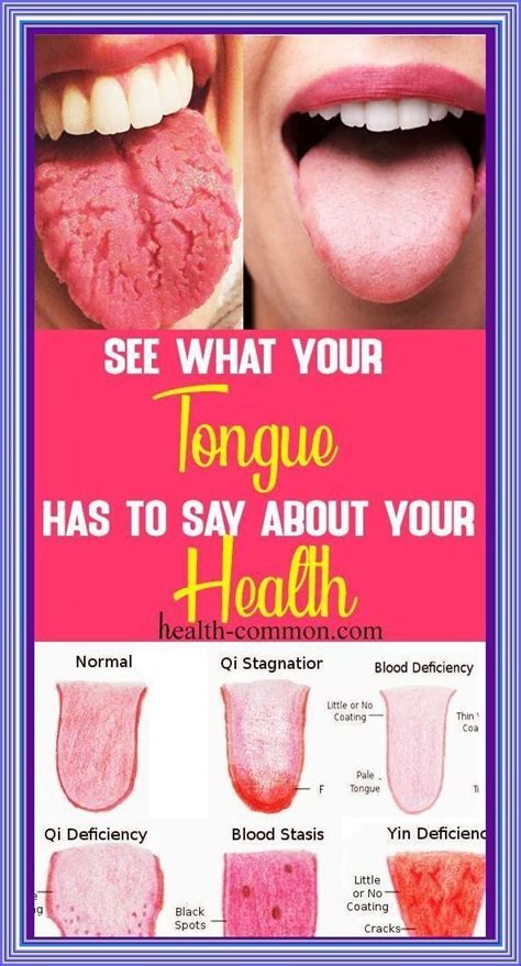 31 home remedies to get rid of mouth ulcers mouth sores – Artofit