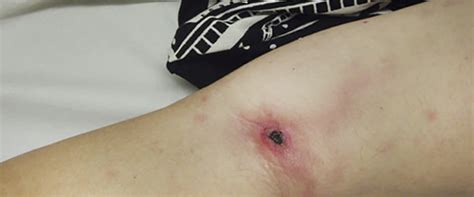 How to Treat Yellow Wound Healing Slough Tissue While Managing Eschar