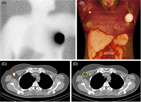 Advanced Diagnostic Imaging Of Sentinel Lymph Node In Early Stage